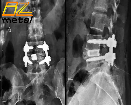 The 2nd Domestic "3D Printed Titanium Alloy Intervertebral Fusion Device” was Approved and Listed!