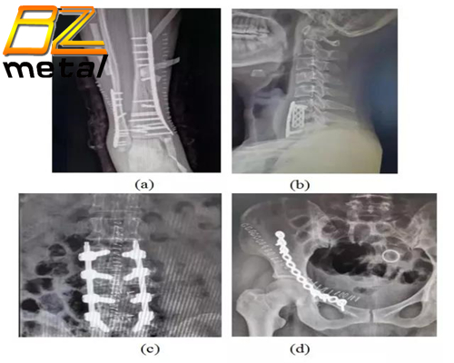 Research Progress On Titanium Alloys For Orthopedics