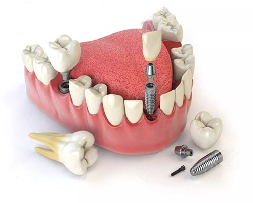 Titanium and Titanium Alloy Materials in Oral Implant Applications