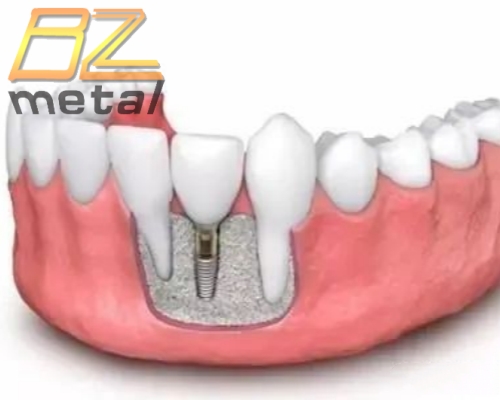 Does Titanium Dental Implants Have An Impact On Magnetic Resonance Examination?